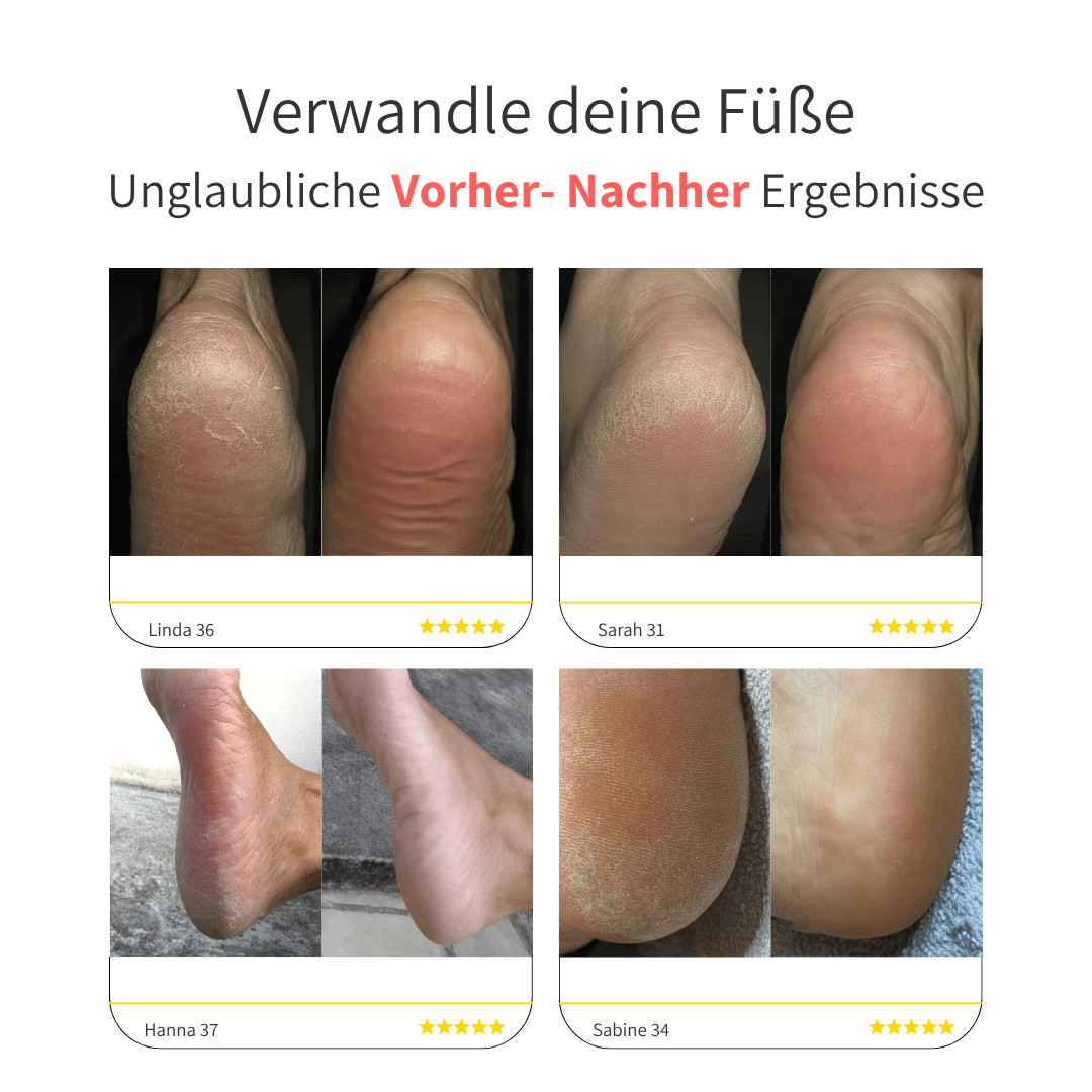 SKNLY™ - Elektrischer Hornhautentferner Pro - SKNLY